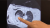 Floridians are still not being diagnosed early enough with lung cancer, study shows